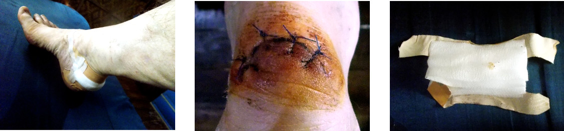Images of dressing change on injured foot