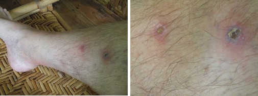 IMages of infected leg healing