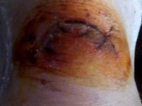 Image of wounded heei