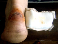 Image of wounded heel