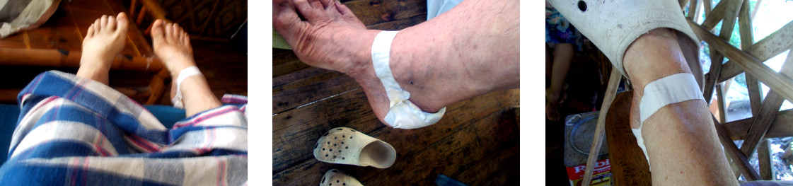 Images of foot with bandage